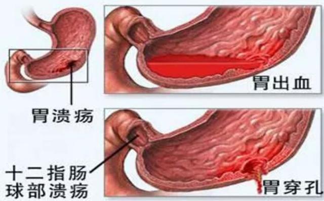 植物药多司马酯构筑全消化道“保护盾”