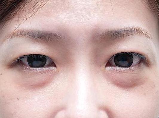 熬夜眼袋重?消除眼袋简单方法,让你和眼袋说再见