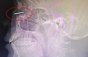 Decorate labour to insert an eye by the eyewinker 1 centimeter, main rescue protects the doctor the