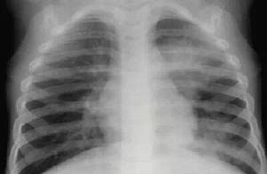 This kind of virus not only encroach enteron, stil