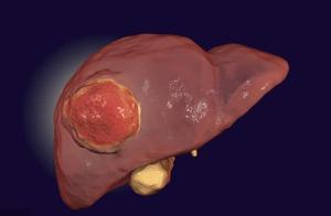 23 years old of lone men, fish liver cancer dies, 