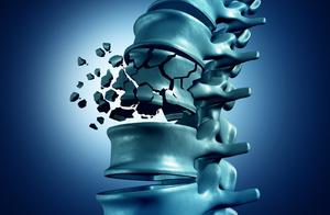 55 years old of men are checked by the doctor be derailed bone is necrotic, be too fond of drink bec