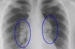 Check-up fish tubercle, polypous, cyst, proliferou