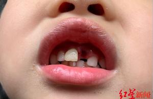 4 years old of child are touched carelessly by scene region staff front tooth, government of parent