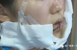 Girl refus is annoyed destroy a look to seam 70 needles, cause trouble person after be being taken a