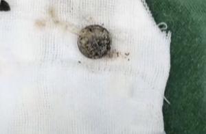 Inside nasal cavity of 7 years old of children large round foreign body, patting CT to look is corru