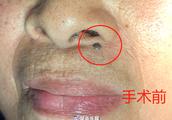 Changsha old lady grows on the face "  Xuan  mole