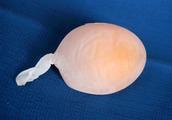 Soft carapace egg, frivolous case egg, deformation egg? Fasten suspicion, it is tubal phlogistic in