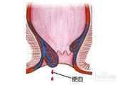 Haemorrhoid haemorrhage nots allow to ignore