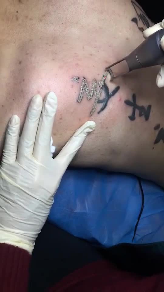 皮淼激光洗纹身