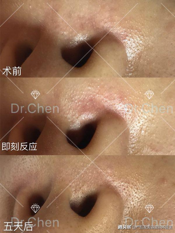 鼻翼沟及鼻子旁红血丝我们用激光治疗轻松搞