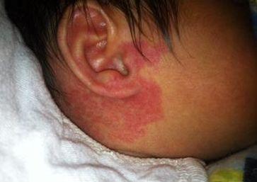 红胎记会随着年龄增长而增厚有些人说,别人家的宝宝红胎记明明消退了